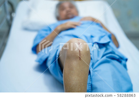 Asian senior or elderly old lady woman patient show her scars surgical total knee joint replacement Suture wound surgery arthroplasty on bed in nursing hospital ward Asian senior or elderly old lady woman patient show her scars surgical total knee joint replacement Suture wound surgery arthroplasty on bed in nursing hospital ward 58288863