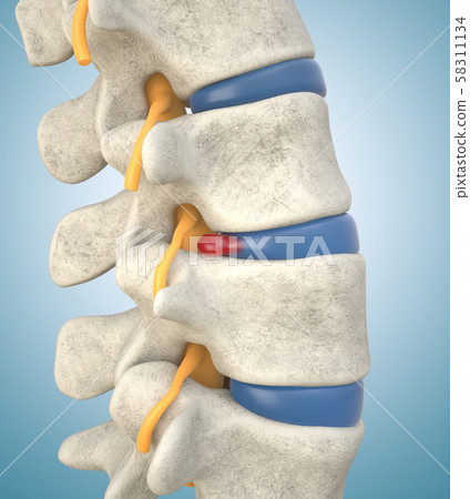 Human lumbar spine model with herniated disc 58311134