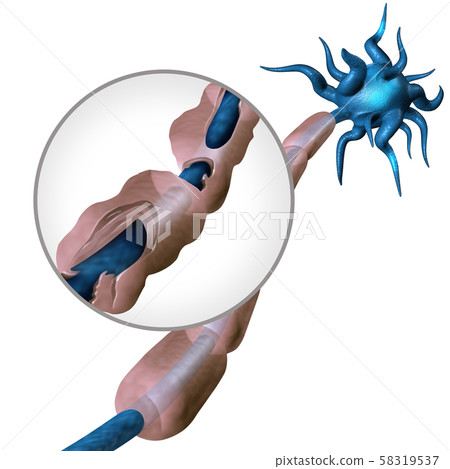 Multiple Sclerosis Diagram 58319537