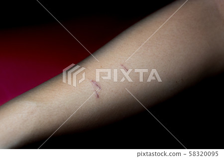 Scab wound on arm Scab wound on arm 58320095