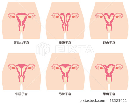子宮畸形 子宮畸形 58325421