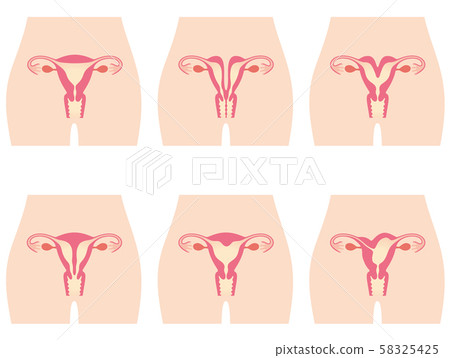 子宮畸形 子宮畸形 58325425