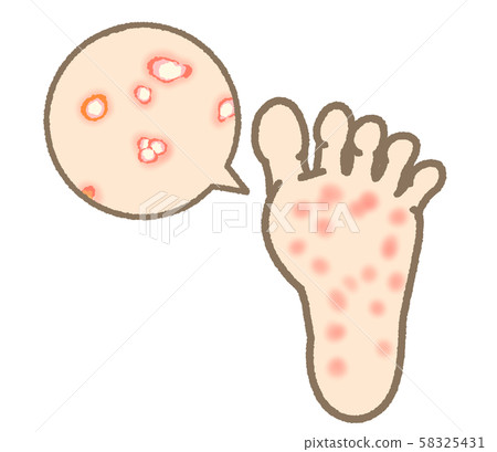 Athlete's foot symptom small blister type expression mild 58325431