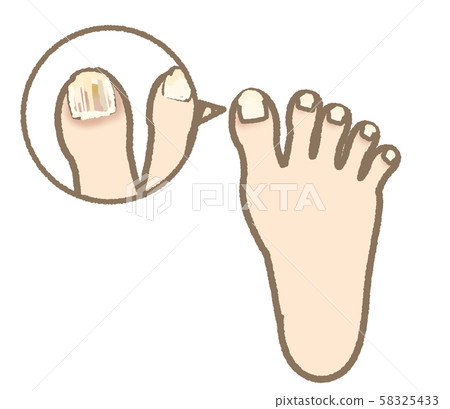 Athlete's foot symptom nail ringworm mild expression 58325433