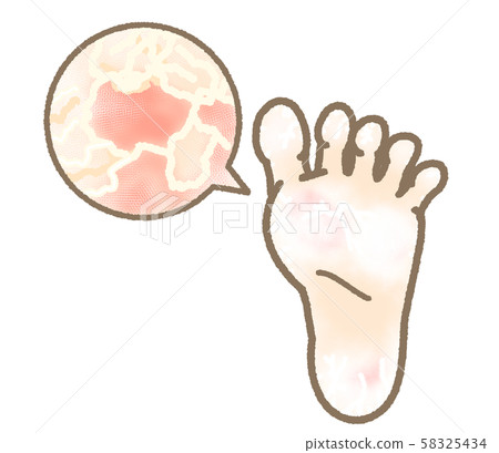 Athlete's foot symptom keratinized expression mild 58325434