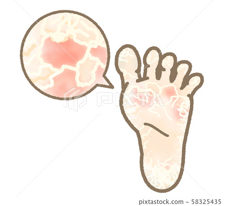 腳癬症狀角質化表達輕微 腳癬症狀角質化表達輕微 58325435