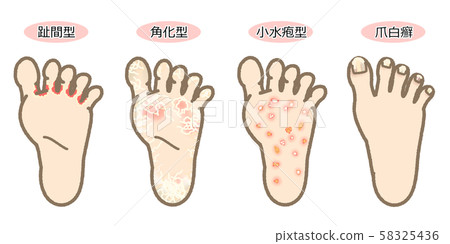 帶有字母的運動員腳症狀列表 58325436