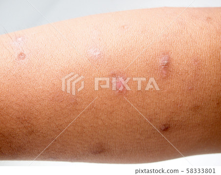 scar on the skin. macro 58333801