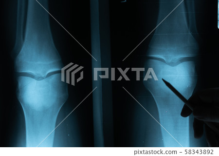 X ray film with doctor's hand to examine 58343892