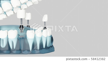 Component of Dental implants. Blue color transparent. 3d illustrations 58412382