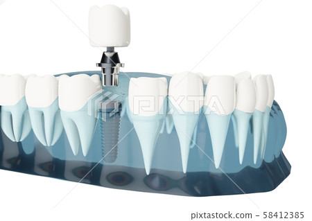 Component of Dental implants. Blue color transparent. 3d illustrations 58412385