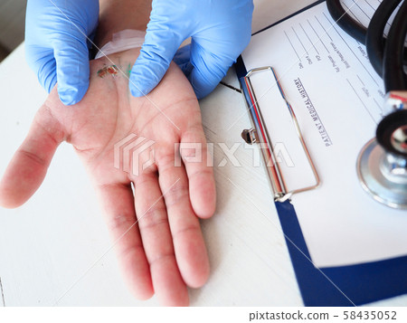 The doctor examines the healing wound of the patient on the hand palm scarring healing 58435052