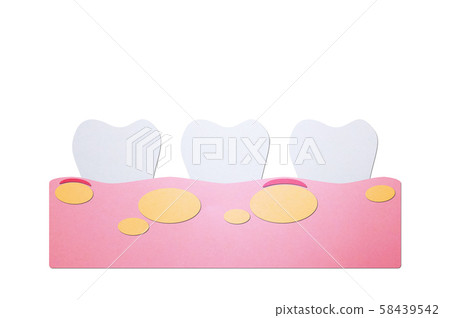 unhealthy teeth because gingivitis with abscess in gum and dental plaque or tartar unhealthy teeth because gingivitis with abscess in gum and dental plaque or tartar 58439542