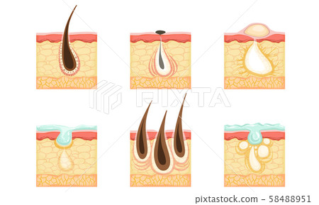 Set of skin images with hair roots, acne and sweat. Vector illustration. Set of skin images with hair roots, acne and sweat. Vector illustration. 58488951