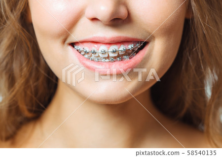 Orthodontic Treatment. Dental Care Concept. Beautiful Woman Healthy Smile close up. Closeup Ceramic Orthodontic Treatment. Dental Care Concept. Beautiful Woman Healthy Smile close up. Closeup Ceramic 58540135
