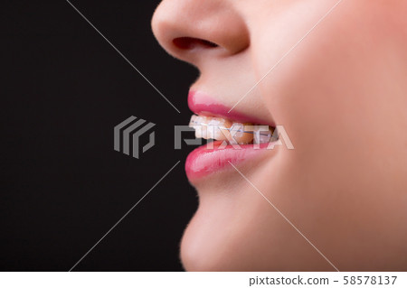 Braces. Beautiful Woman healthy smile close up. 58578137