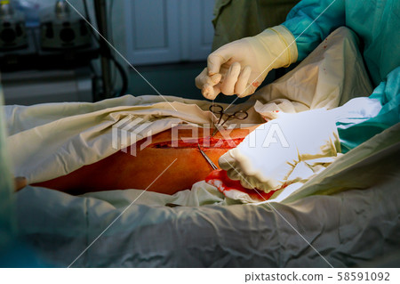 Leg surgery by surgeon in operating room Leg surgery by surgeon in operating room 58591092