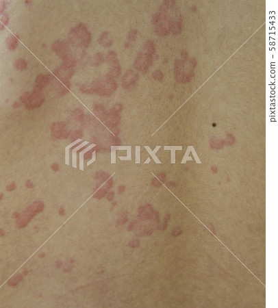 Hives' back skin 58715433