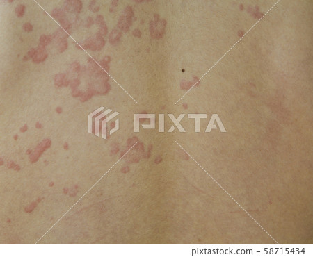 Hives' back skin 58715434