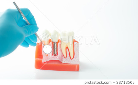 Dental implant model on white background. 58718503