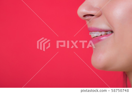 Ceramic and Metal Braces on Teeth. Dental Braces Smile. Orthodontic Treatment. Closeup Smiling Face Ceramic and Metal Braces on Teeth. Dental Braces Smile. Orthodontic Treatment. Closeup Smiling Face 58750748