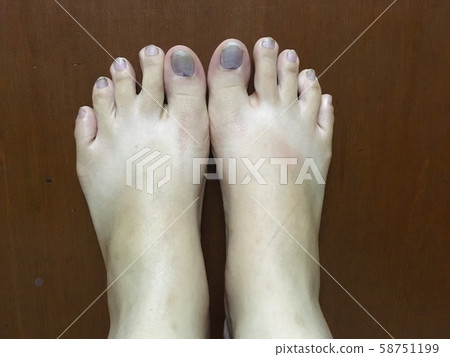 Injured of foot purple bruise toenail, close up view on wooden floor Injured of foot purple bruise toenail, close up view on wooden floor 58751199