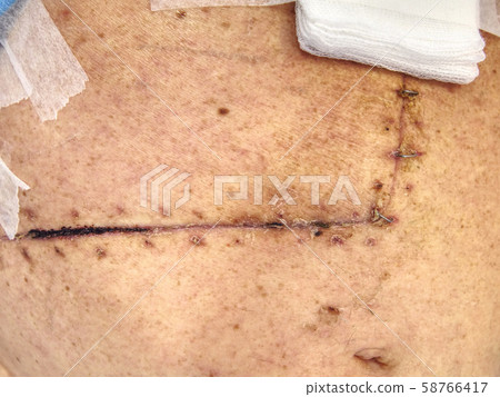 Patient  with abdominal scars after gallbladder 58766417