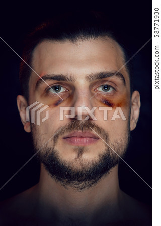Young man with bruise black eye hematoma, violence victim. 58771930