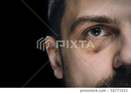 Man with bruise eye hematoma. Wounded victim with black eye. Man with bruise eye hematoma. Wounded victim with black eye. 58771932