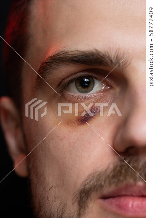 Man with shiner bruise black eye hematoma Man with shiner bruise black eye hematoma 58772409