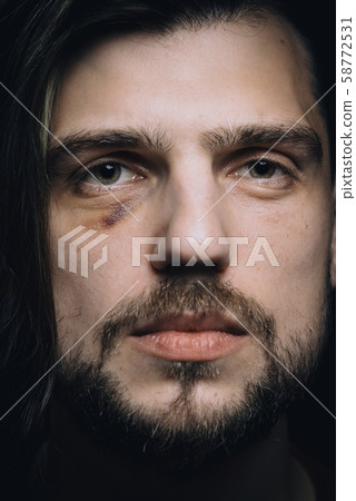 Sad man with black eye, violence domestic abuse concept 58772531
