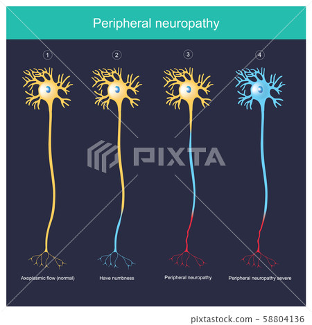 Peripheral neuropathy.  Explain illustration for 58804136