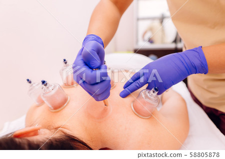 Therapist giving cupping therapy to woman- Hijama 58805878