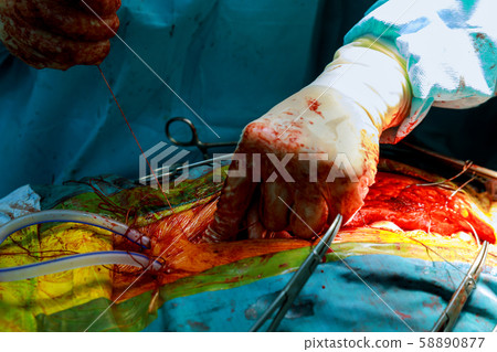 Making sure the layers of the skin are sutured 58890877