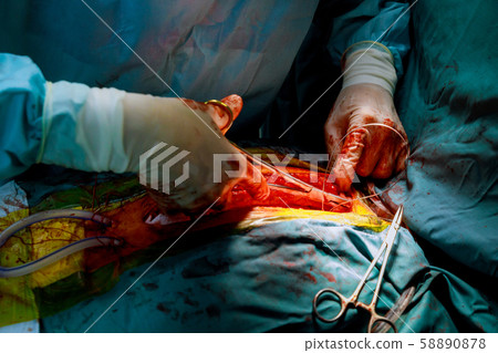 Staring to close the abdomen with a suture in the Staring to close the abdomen with a suture in the 58890878