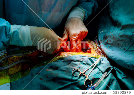 Closing Thoracic Cavity with couple of drains Closing Thoracic Cavity with couple of drains 58890879