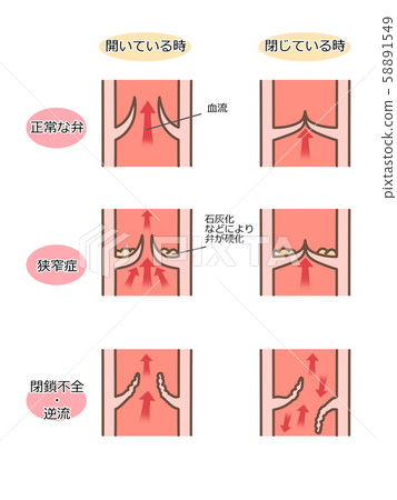 瓣膜性心髒病,瓣膜,橫斷面,字母 瓣膜性心髒病,瓣膜,橫斷面,字母 58891549
