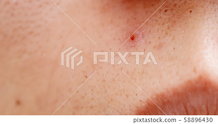 acne on the woman face acne on the woman face 58896430