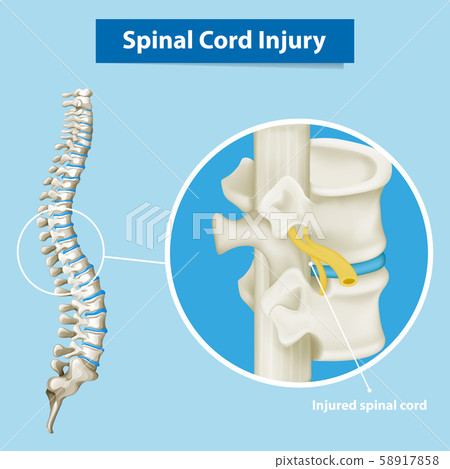Diagram showing spinal cord injury Diagram showing spinal cord injury 58917858
