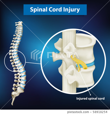 Diagram showing spinal cord injury Diagram showing spinal cord injury 58918254
