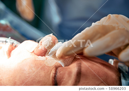 Rhinoplasty close-up. An operating team of several doctors performs nose surgery. Curved septum 58966203