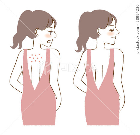 Back acne female before and after skin care skin care illustration Back acne female before and after skin care skin care illustration 58994236