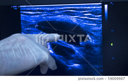 EPI dry needling ultrasound scan EPI dry needling ultrasound scan 59009987