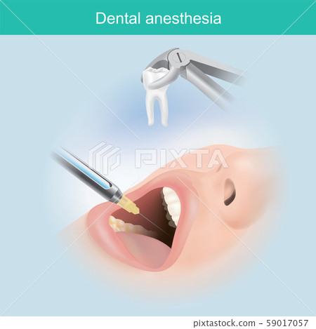Dental anaesthesia. A jet injection aims a liquid Dental anaesthesia. A jet injection aims a liquid 59017057