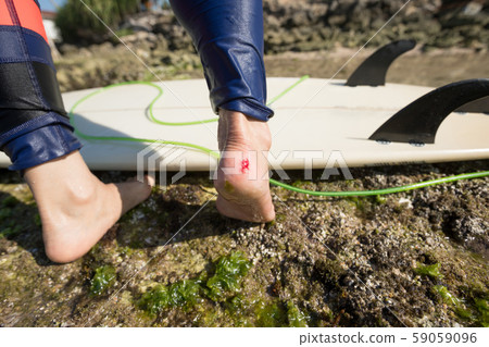 Woman surfer got injury on heel while surfing Woman surfer got injury on heel while surfing 59059096