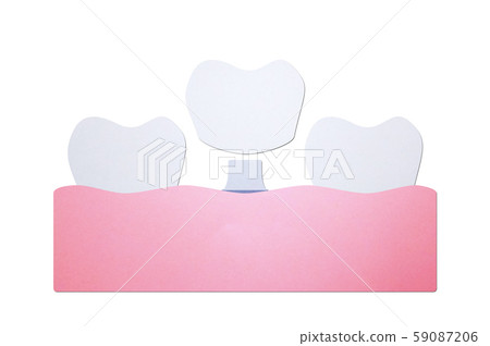 tooth implant, installation process and change new root for teeth 59087206