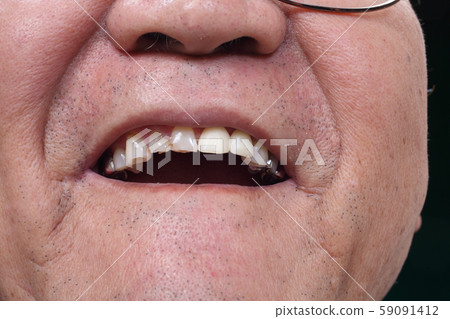 Dentures, temporary teeth 59091412
