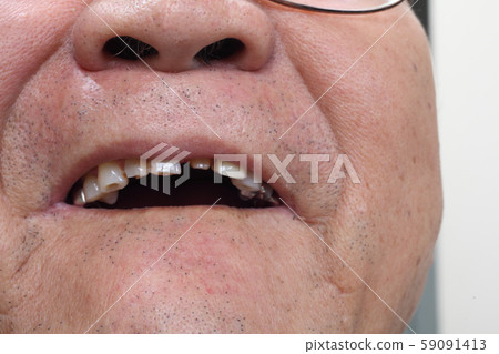Taken dentures and temporary teeth 59091413