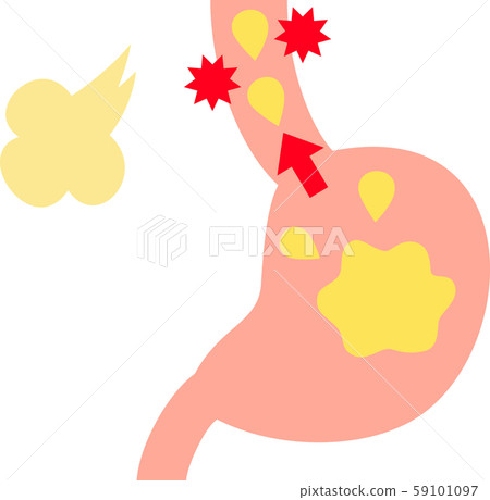 Stomach and esophagus causing reflux esophagitis 59101097