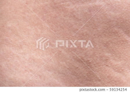 Texture of human's body with the stretch marks, closeup photo Texture of human's body with the stretch marks, closeup photo 59134254